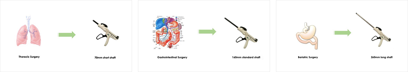 Surgeries_Using_Endoscopic_Linear_Cutter_Stapler.jpg