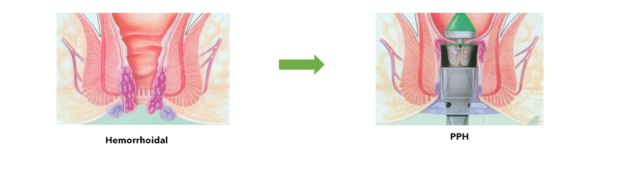 hemorrhoidal-stapler-indication.jpg
